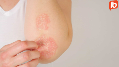 Pesquisadores desenvolvem tratamento natural contra a psoríase